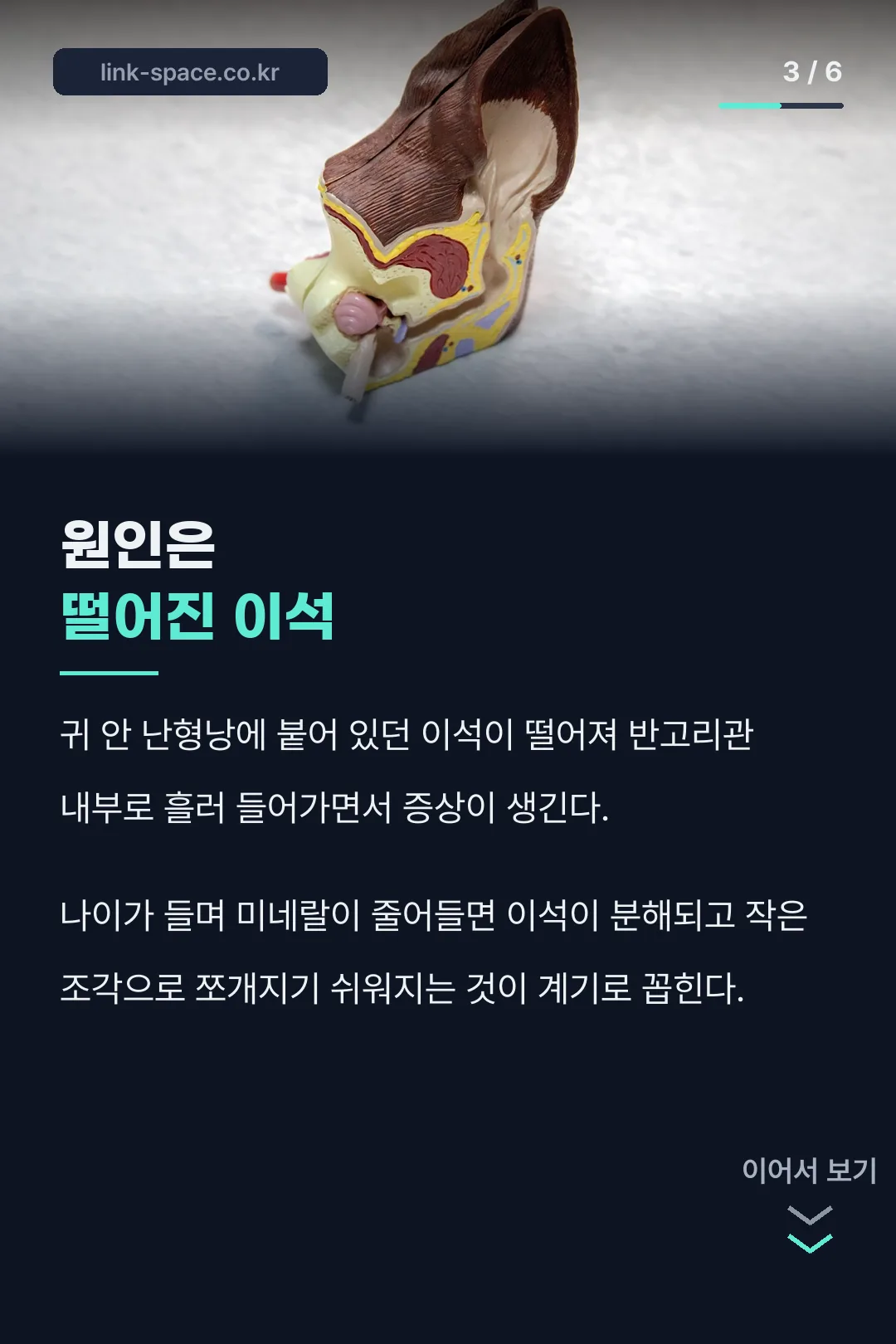 원인은 떨어진 이석